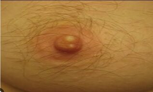 Links to /book-your-appointment PCOS, PCOD, nipple hair, electrolysis, permanent hair removal