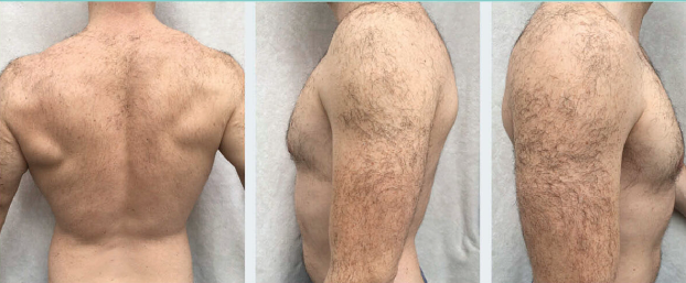 6 month post-treatment shows dense hair growth on the upper arms and upper back