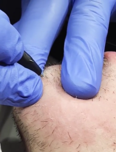 Electrolysis being done on a chin