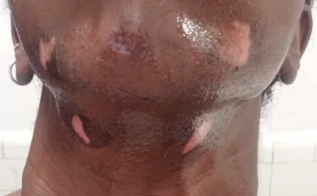 Woman with severe burns on her chin from laser hair removal