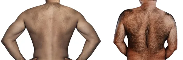 Comparison of male backs with light and heavy hair growth showing different electrolysis time requirements