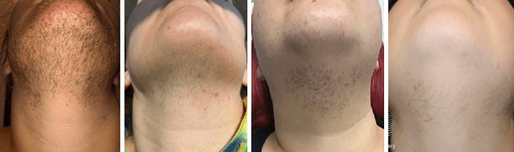 Different facial hair growth patterns on chins affecting electrolysis treatment duration