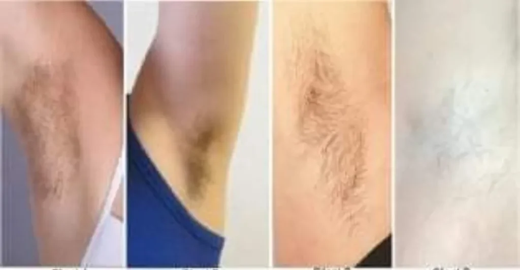 Examples of underarm hair with different densities affecting electrolysis treatment time