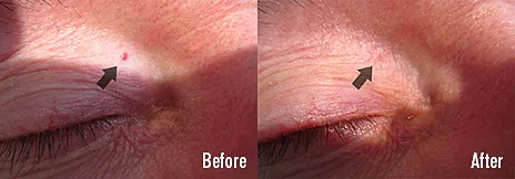 Cherry angioma near the eye before and after treatment