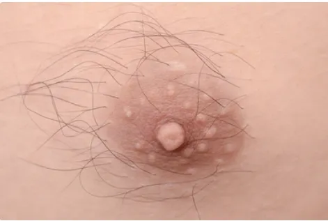 Close-up image representing electrolysis hair removal for nipple and breast area