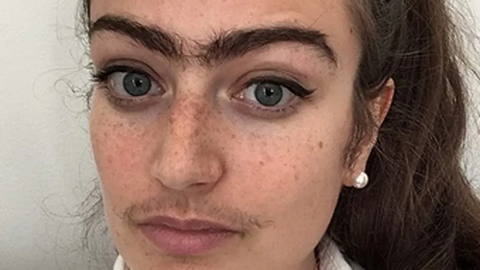 Facial hirsutism in woman with PCOS showing excess dark facial hair