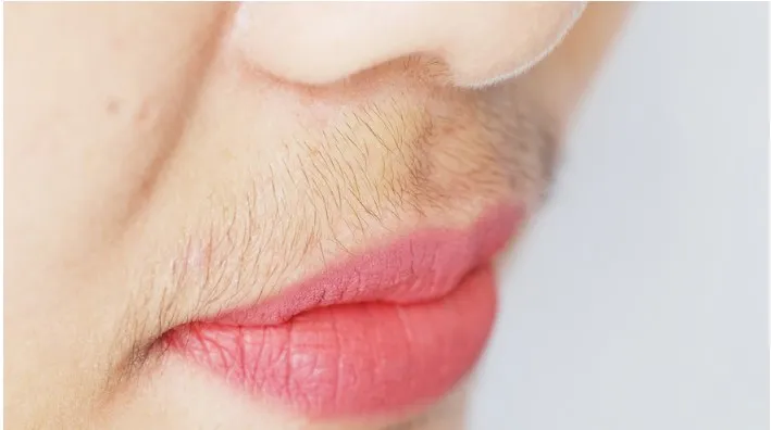 Upper lip facial hair in woman with PCOS and hirsutism