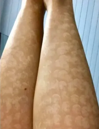 Skin damage and discoloration after laser hair removal treatment