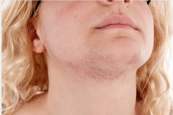 PCOS facial hair on chin and neck with visible excess hair growth