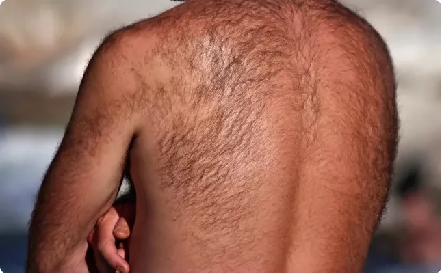 back hair electrolysis for men permanent hair removal