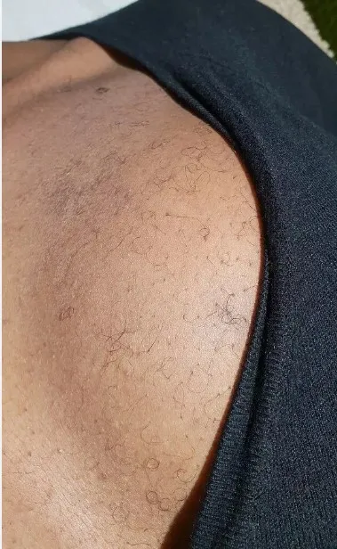 Excess body hair on shoulder due to hirsutism and hormonal imbalance
