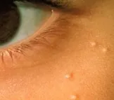 Milia around the eyes, small white keratin cysts on facial skin
