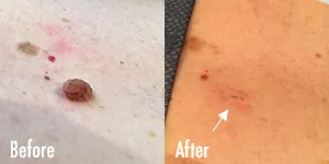 Skin tag before and after removal