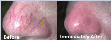 Spider veins on the nose before and after treatment