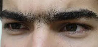 unibrow electrolysis for men permanent hair removal