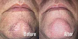 Before and after treatment of visible facial capillaries on the chin