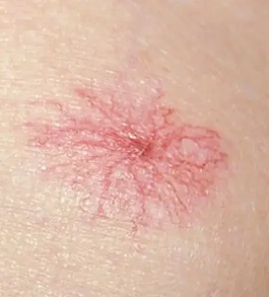 Spider angioma on the skin showing a central red spot with radiating blood vessels